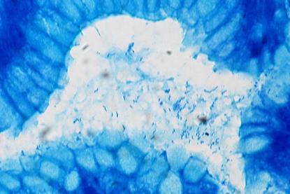 Helicobacter_pylori,_Gastric_Biopsy,_Giemsa_Stain_(5517582111)