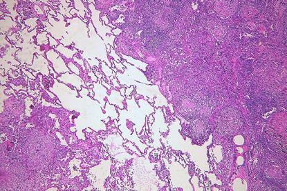 Pulmonary_tuberculosis_(6545189731)