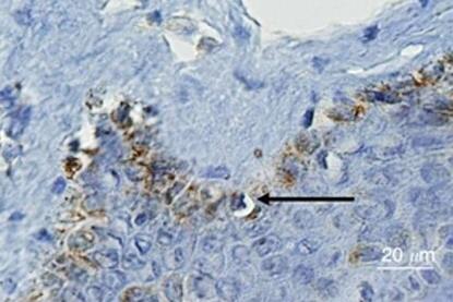 Human_papilloma_virus_(HPV)_1618_E6_staining_in_normal_and_ductal_carcinoma_in_situ_(DCIS)_breast_cancer_specimens