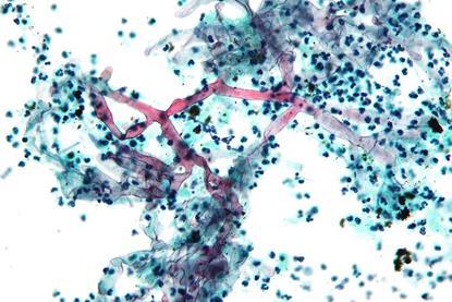 Zygomycosis