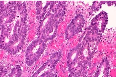 Micrograph_of_poorly_differentiated_colorectal_carcinoma