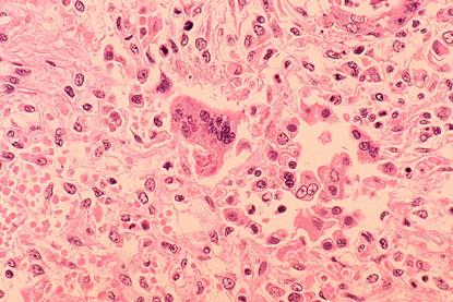 Measles_pneumonia_-_Histopathology