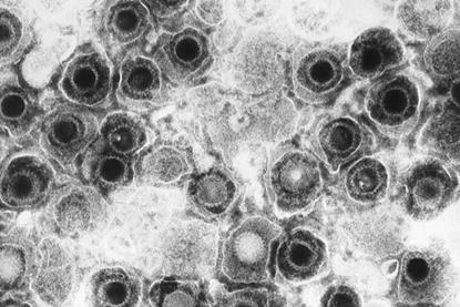 Herpes_simplex_virions,_TEM
