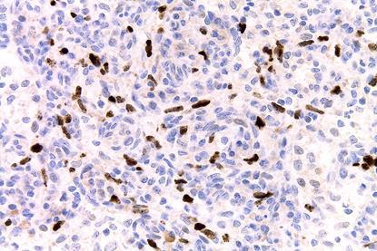 LANA-1_immunostain_in_a_Kaposi_sarcoma_in_a_patient_with_HHV8-associated_MCD