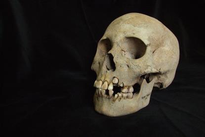 The skull of a 9-11 year old girl
