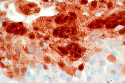 Low-Grade_Papillary_Urothelial_Tumor_of_Bladder_with_Herpes_Simplex_Virus_Infection_(8534832864)