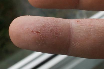 Eczema_versus_Fingerprints_2009