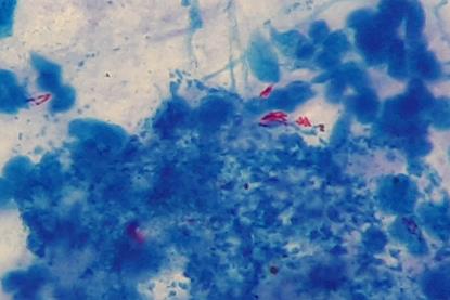 Mycobacterium_tuberculosis_in_Ziehl-Neelsen_stained_smear_of_sputum