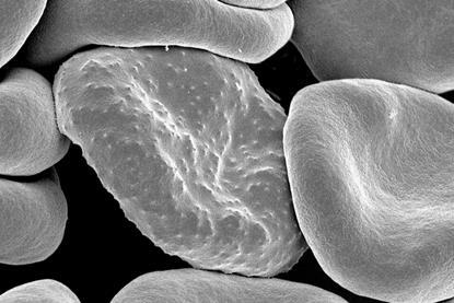 Red_blood_cells_infected_with_malaria