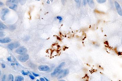 Immunohistochemical_detection_of_Helicobacter_pylori_histopathology