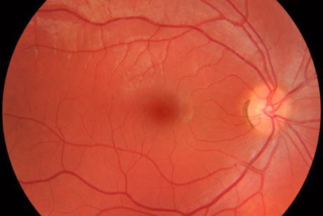 Fundus_photograph_of_normal_right_eye