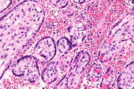 Maternal_malaria_placenta_-_very_high_mag