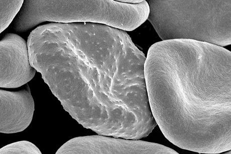 Red_blood_cells_infected_with_malaria