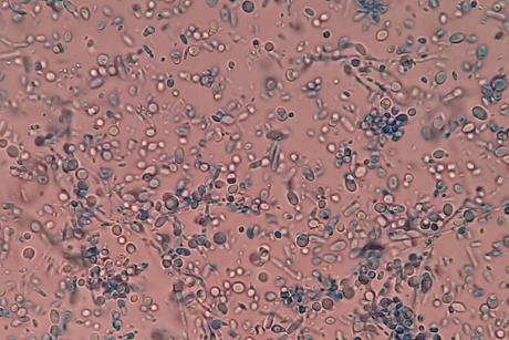 Malassezia_in_LPCB_Tease_Mount_Microscopy
