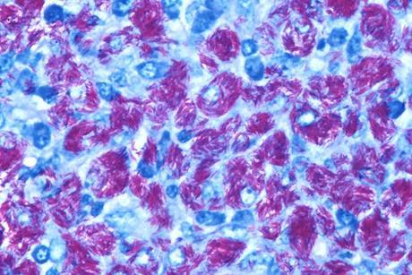 Lymph_node_-_Atypical_mycobacterial_infection_(MAI)_4
