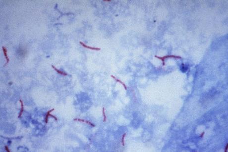 Mycobacterium_tuberculosis_Ziehl-Neelsen_stain_02