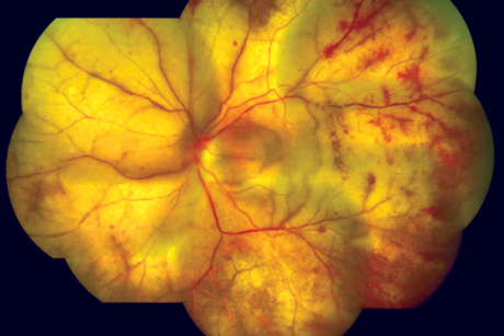 PMID20029144_05_progressive_outer_retinal_necrosis_-_cracked_mud