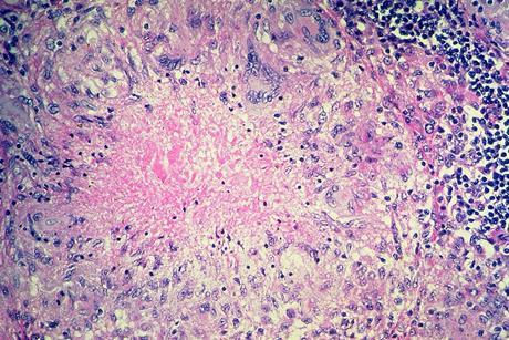 Pulmonary_tuberculosis_-_Necrotizing_granuloma_(6545186957)
