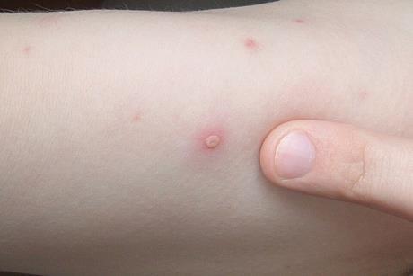 Chickenpox_blister_2006.01.06