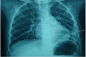 Pneumonia_and_pleural_effusions_on_the_lower_left_lung_(2.5_y.o._child)