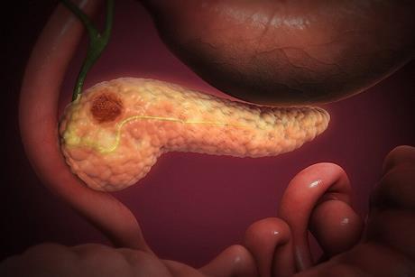 Pancreatic_Cancer