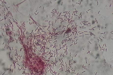 Gram_negative_rods_(GNRs)_of_Pseudomonas_aeruginosa_in_Gram_staining_of_BAL