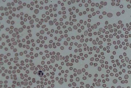 Thrombocytopenia_1