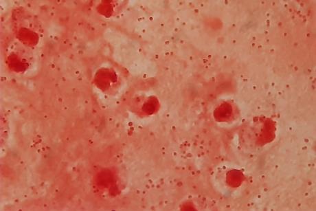 Gram_negative_coccobacilli_of_Acinetobacter_in_bronchoalveolar_lavage_(BAL)_Gram_staining