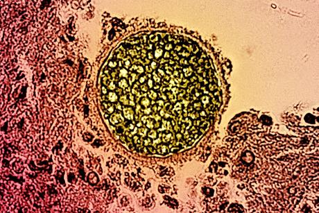 Coccidioides_fungal_spherule_found_in_a_tissue_sample_of_this_organism_that_causes_coccidioidomycosis,_also_known_as_Valley_Fever