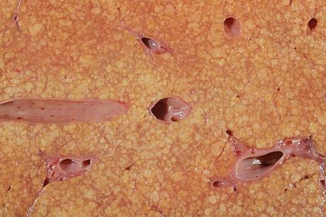 Cirrhosis_liver