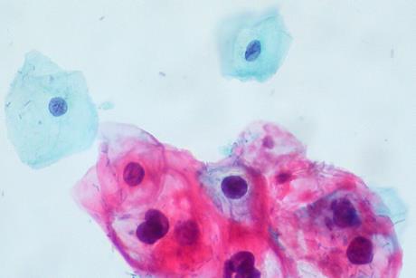 CIN_1-HPV_on_ThinPrep