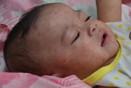 Measles_child_Philippines