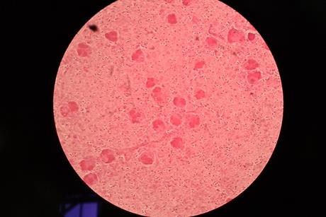 Encapsulated_strain_of_Streptococcus_pneumoniae_in_clinical_sample_sputum_Gram_staining