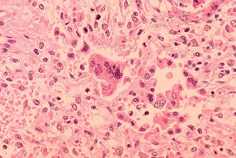 Measles_pneumonia_-_Histopathology