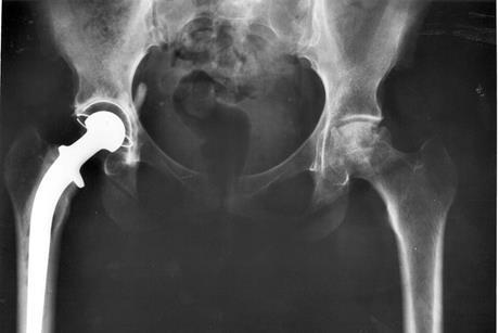 Hip_replacement_Image_3684-PH