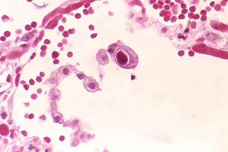 Cytomegalovirus_01