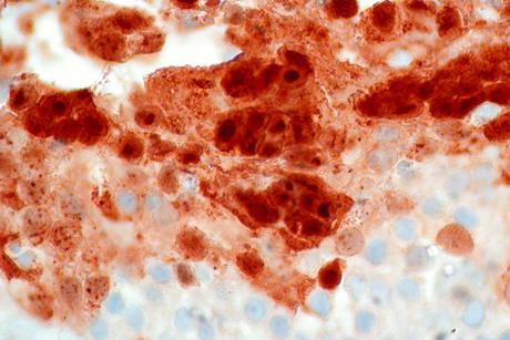 Low-Grade_Papillary_Urothelial_Tumor_of_Bladder_with_Herpes_Simplex_Virus_Infection_(8534832864)