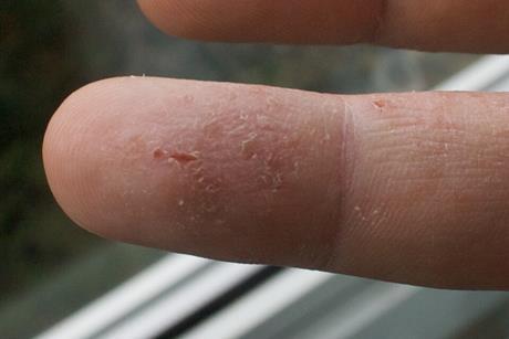 Eczema_versus_Fingerprints_2009