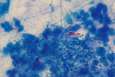 Mycobacterium_tuberculosis_in_Ziehl-Neelsen_stained_smear_of_sputum (1)