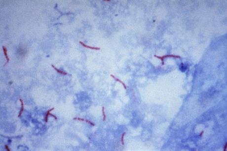 Mycobacterium_tuberculosis_Ziehl-Neelsen_stain_02 (1)