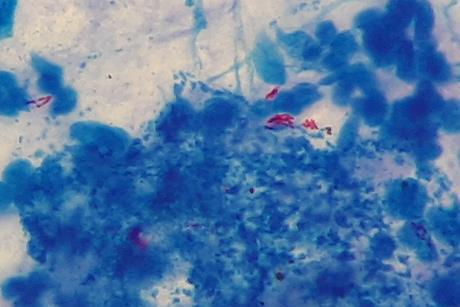 Mycobacterium_tuberculosis_in_Ziehl-Neelsen_stained_smear_of_sputum
