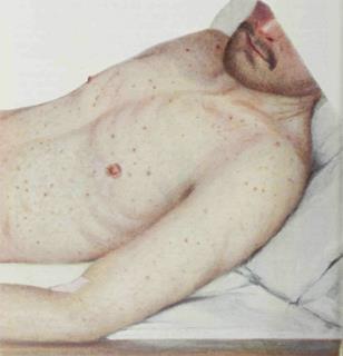 Epidemic Typhus, macular rash