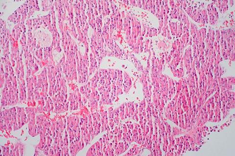 Hepatocellular_Carcinoma_(7205111796)