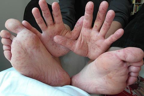 800px-Hand_Foot_Mouth_Disease_Adult_36Years