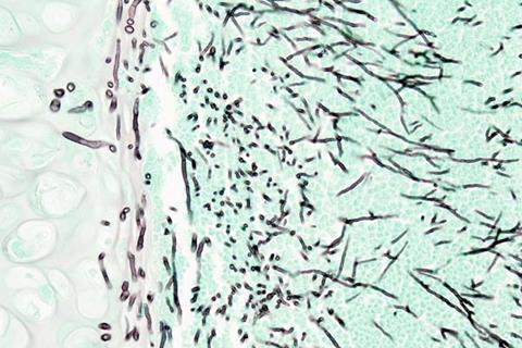 Pulmonary_aspergillosis_(1)_invasive_type