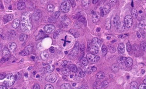 Pathologic_mitosis