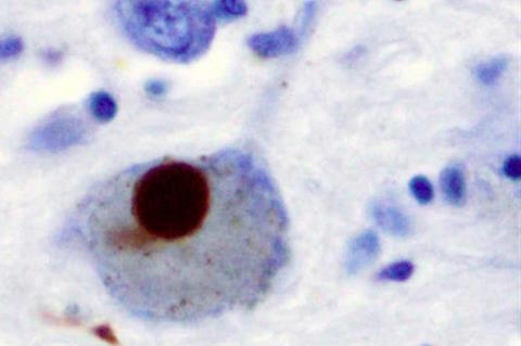 Lewy_Body_alphaSynuclein