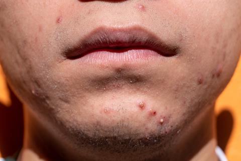 acne-gcaaf9e3a1_1280