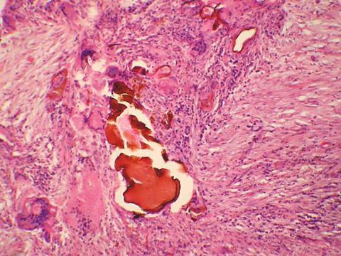 Fecal_matter_foreign_body