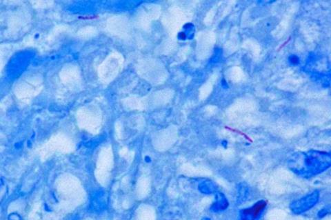 Mycobacterium_tuberculosis_Ziehl-Neelsen_stain_640